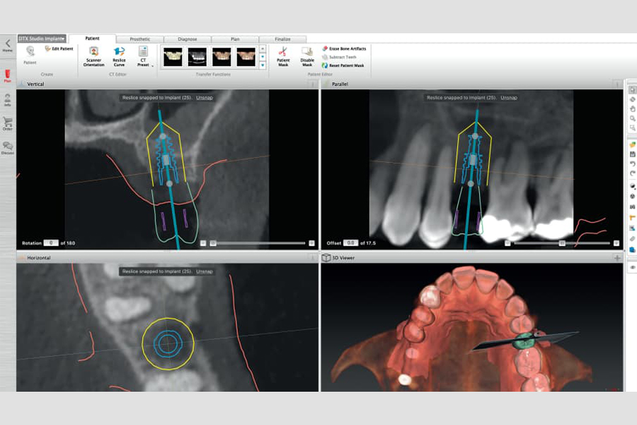 DTX Studio? Implantによる治療計画