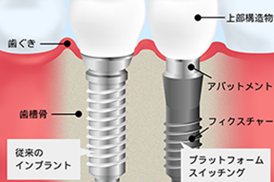 骨が吸収されにくいシステムを採用しています